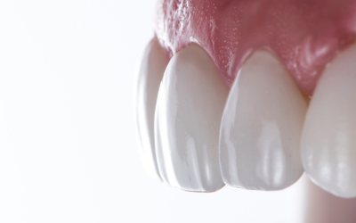 Tout savoir sur les facettes dentaires