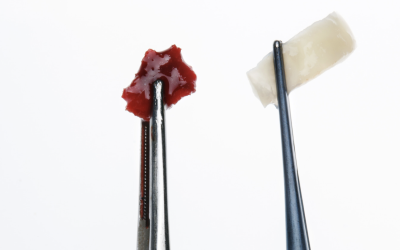 Qu&rsquo;est-ce qu&rsquo;une greffe en dentisterie ?